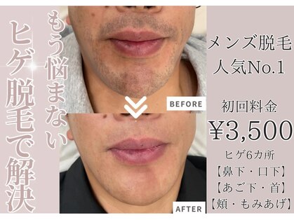 エピリス(EPILIS)の写真