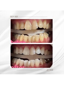 ホワイトニングセンター 大阪羽曳野店/歯科提携ホワイトニング症例