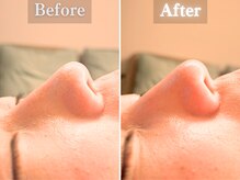 ボーンオム(Born Homme)/毛穴洗浄＋美容液導入：30代女性