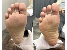 foot care