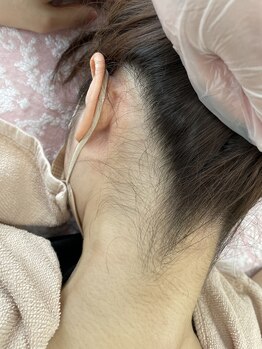 ルナベイビー(Luna Baby)/うなじワックス　BEFORE