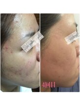 サロン リュンヌ(salon lune)/ハーブピーリング