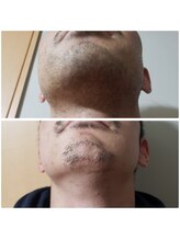 エステティック らぽーる(Rapport)/ヒゲ爆抜けモード