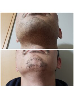 エステティック らぽーる(Rapport)/ヒゲ爆抜けモード