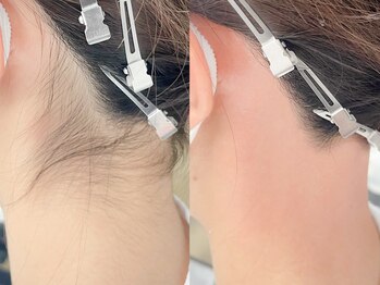 ネリネ 天神(nerine)/うなじWax♪ブライダル脱毛