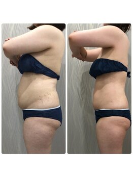 ベルネ(BELLUNE)/ベルネ式フォースカッター