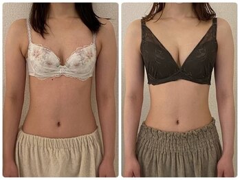 美人バスト 町田店/バストアップ◇症例◇