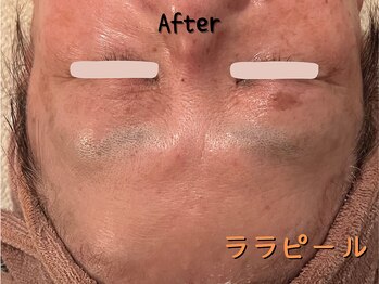 ダイヤモンド リーエンダ(Diamond leende)/ララピール