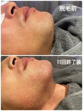 ワイズサロン(Y's salon)/ヒゲ脱毛11回目終了後