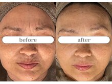 リスタ(RSTA)/【BEFORE/AFTER】