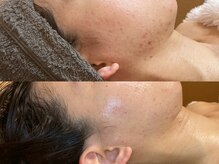 ビジュープラス 広島店(Bijou+)/【20代/ニキビケア】