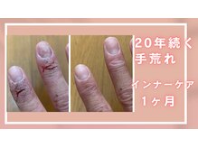 シャルナ(charna)/20年の手荒れ改善