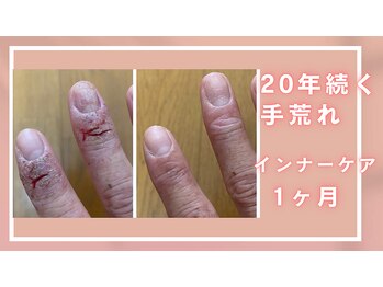 シャルナ(charna)/20年の手荒れ改善