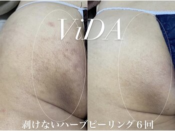 ヴィーダ 渋谷松濤(ViDA)/REVIお尻ハーブピーリング