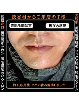 ディースタイル 北谷店(Dstyle)/那覇メンズ脱毛 Before After