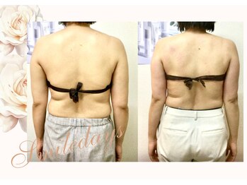 スマイルデイズ(Smiledays)/2回目の施術