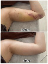 インディバジェム(GEM)/ビフォーアフター