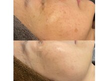 モルセラ(Moluccella)/13回の施術