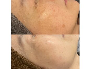 モルセラ(Moluccella)/13回の施術