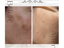 ピュアル 川口(Pual)/【頬に出来るシミ】Pual症例