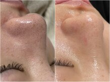 トリニティーベル(Trinity bel)/【プラズマフェイシャル】