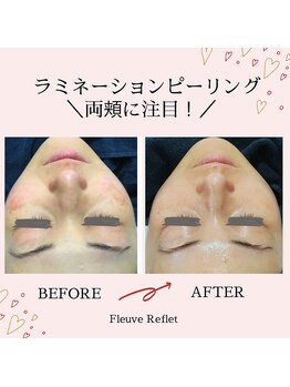 フルーヴ ルフレ(Fleuve Reflet)/両頬の変化に注目！！！