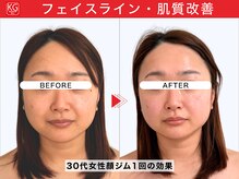 顔ジム 麻布店/30代女性顔ジム1回の効果