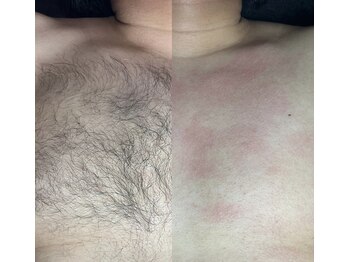 アリシア ビューティーサロン(Alicia)/【メンズ】胸