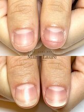 マリーロール 梅田店(Marie Laure)/自爪育成/深爪矯正/ネイルケア