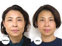 グランルーツ(GranRoots)/小顔矯正before/after