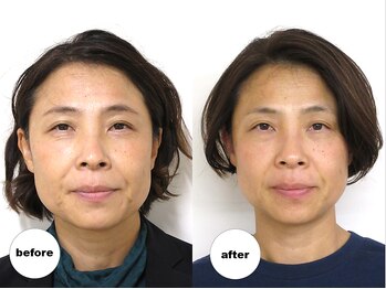 グランルーツ(GranRoots)/小顔矯正before/after