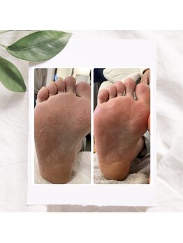 シャンス(chance)/カサカサかかと解消！角質ケア