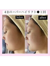 ルピナス ヒサヤ(LUPINUS hisaya)/最高峰小顔4Dスーパーハイリフト