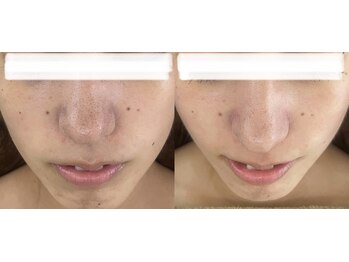 マーレン(Malen)/【症例写真】施術1回