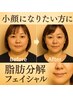 【30～50代人気支持率No1】たるみ・ほうれい線・改善！脂肪分解フェイシャル