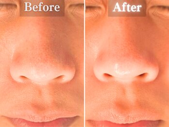 ボーンオム(Born Homme)/毛穴洗浄＋美容液導入：30代女性