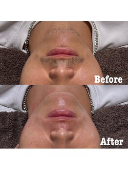 プレシャス(Precious)/髭のワックス脱毛1回目