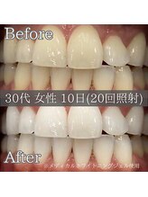 シカホワイトニングトウキョウ 笹塚店(CICA Whitening Tokyo)/ビフォーアフター（30代女性）