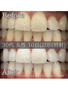 シカホワイトニングトウキョウ 笹塚店(CICA Whitening Tokyo)/ビフォーアフター(30代女性)