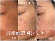 メイメイ(MAY MAY)の雰囲気(シミケアで1週間後に変化を実感♪気になるシミにアプローチ!)