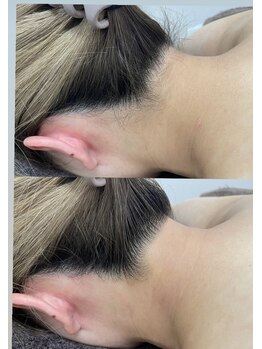 カルディエ(Cardie)/うなじ脱毛　ビフォーアフター