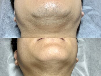 エモーショナル 姫路(Emotional)/ヒゲ脱毛で青ヒゲから卒業♪