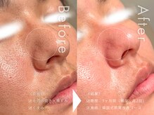 セルフミー 恵比寿(SELF Me...)の雰囲気（クリニック提携なのでプロ用のハーブピーリングがお手軽に施術◎）
