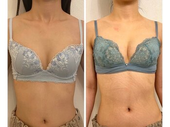 美人バスト 町田店/バストアップ◇症例◇