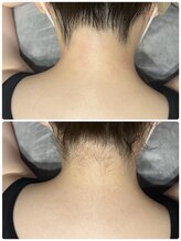 エイチビューティーラボ(h Beauty labo)/うなじ脱毛