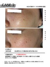 ミウル 天王寺店(miulu)/30代女性/シミ照射2回