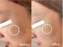 ブランシェ 富山店 × 椿/シミケア　『30代お客様』