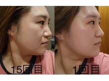 ケイビューティーサロン(K BeautySalon)/コルギでどこまで変わる？