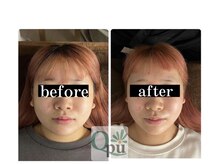 キュープ 鹿児島西陵店(Qpu)/通常コース4回での変化