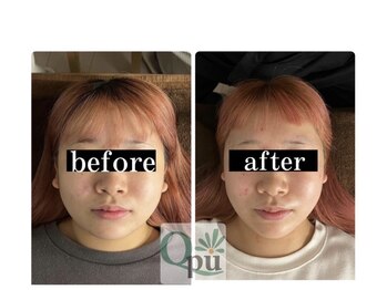 キュープ 鹿児島西陵店(Qpu)/通常コース4回での変化